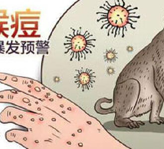 专家:未来猴痘或出现家庭内传播